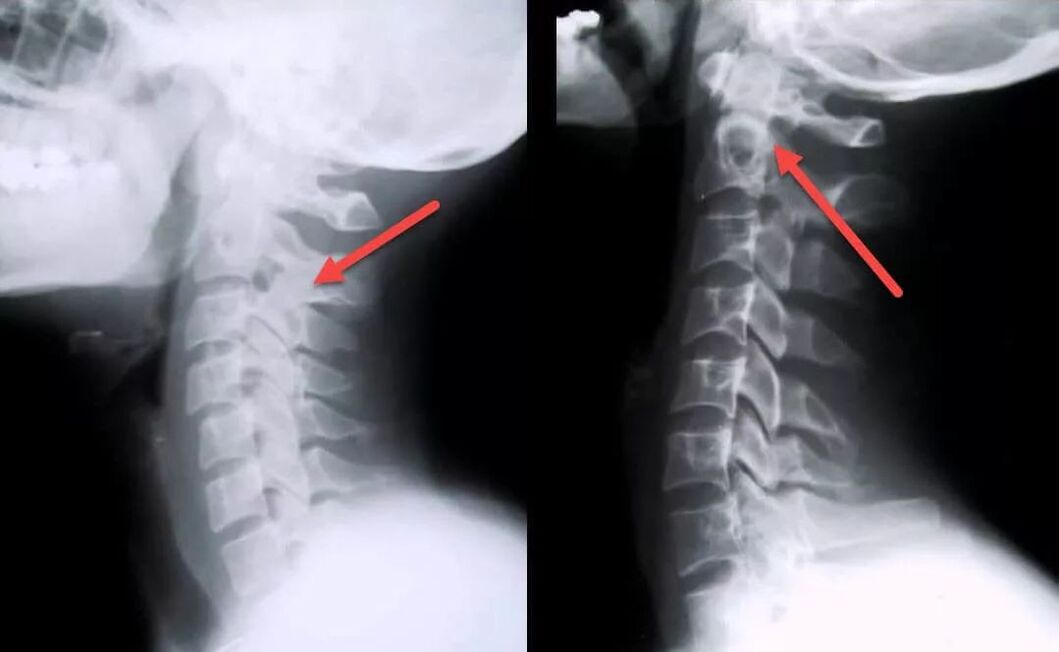 diagnosticul osteocondrozei cervicale