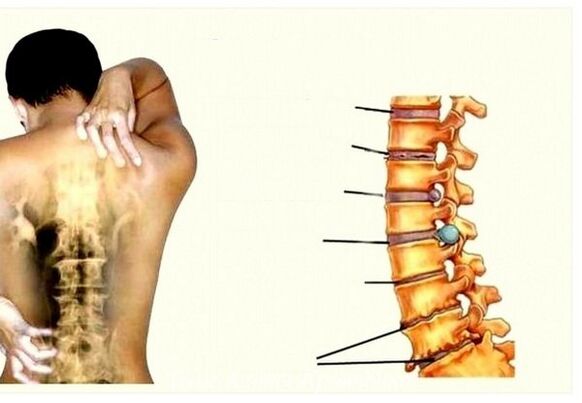 Etapele osteochondrozei cervicale