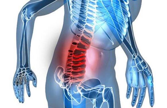 Deformarea coloanei vertebrale în a patra etapă a osteocondrozei lombare