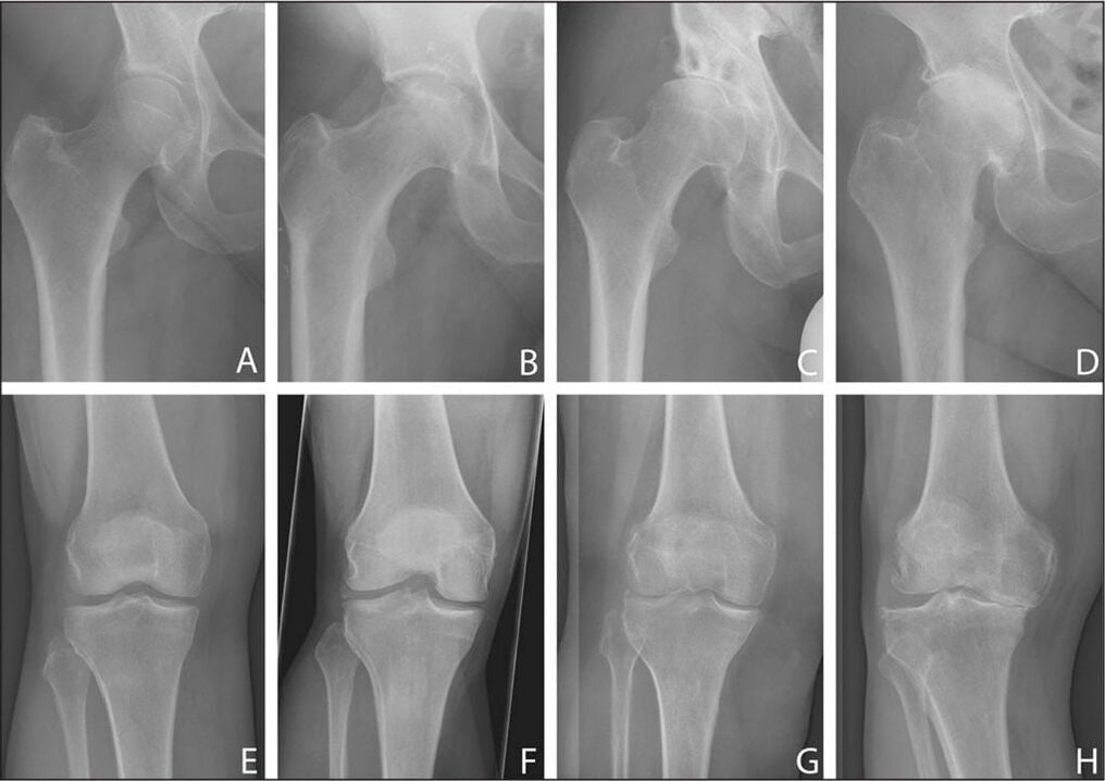 Etapele dezvoltării artrozei articulare pe radiografie